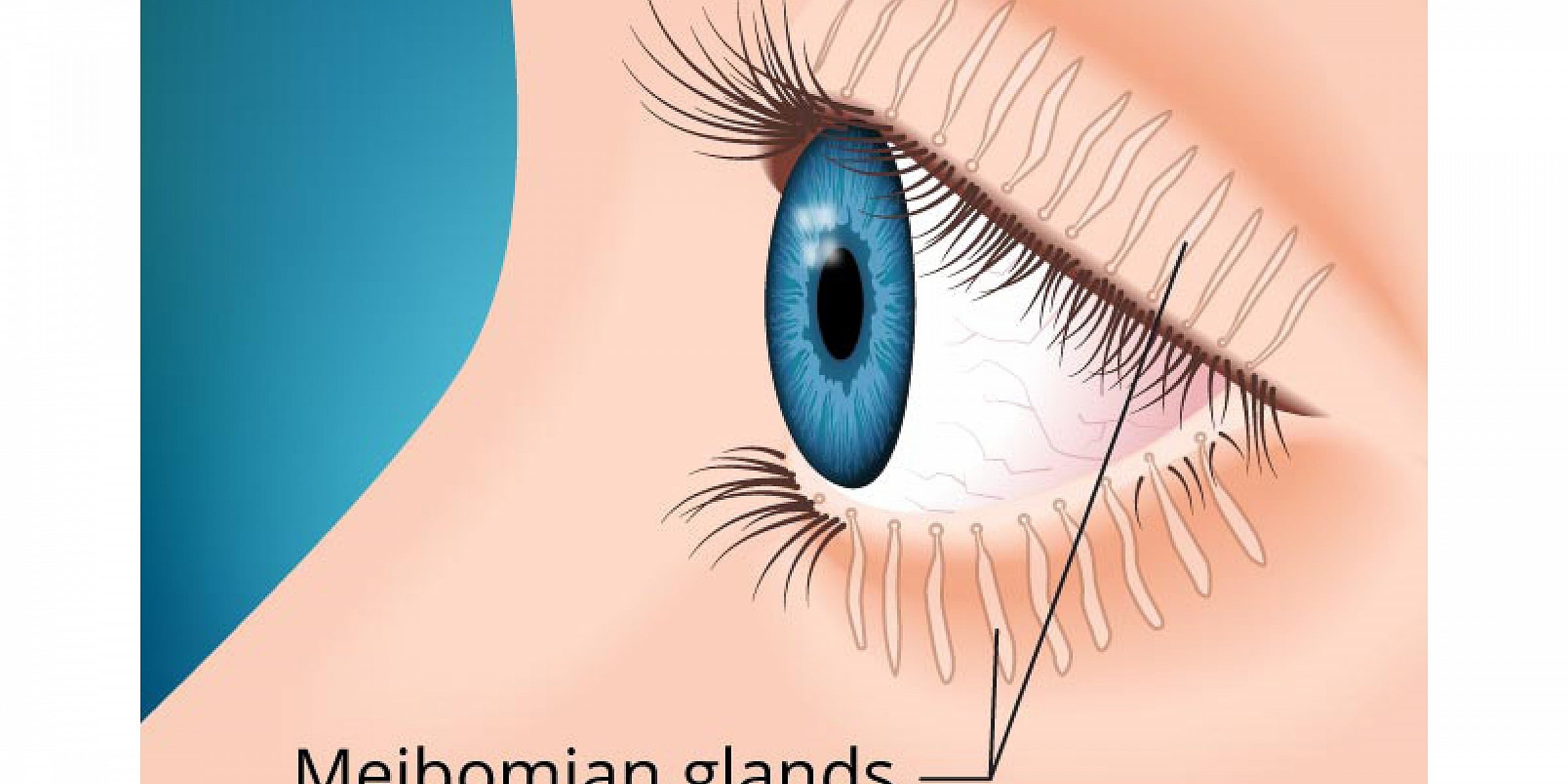 Meibomian Gland Dysfunction MGD Canon Street Optometrists